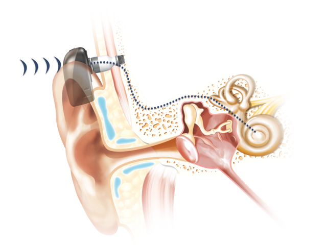 Cochlear_BoneConduction-how_it_works_Sound_Baha6