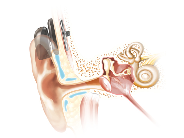 Cochlear_Bone_Conduction_Baha6_Attract