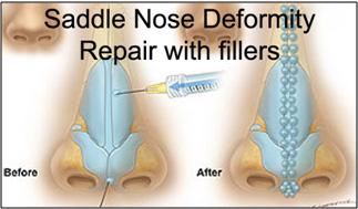 nose_deformity