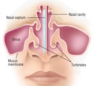Deviated Septum