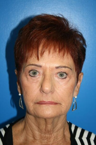 Deep Plane Facelift Before & After Gallery - Patient 883123 - Image 1