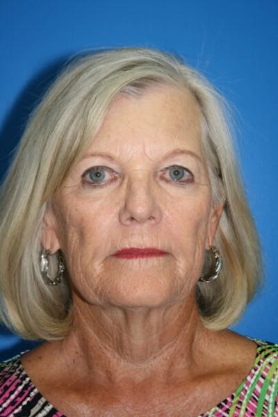 Deep Plane Facelift Before & After Gallery - Patient 143472 - Image 1