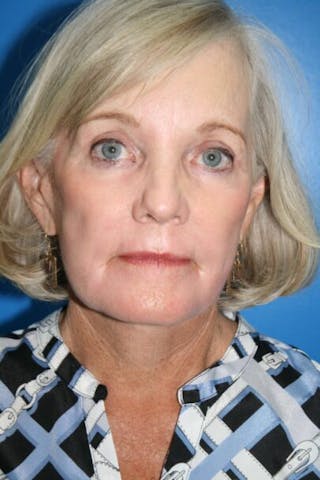 Neck Lift Before & After Gallery - Patient 920940 - Image 2