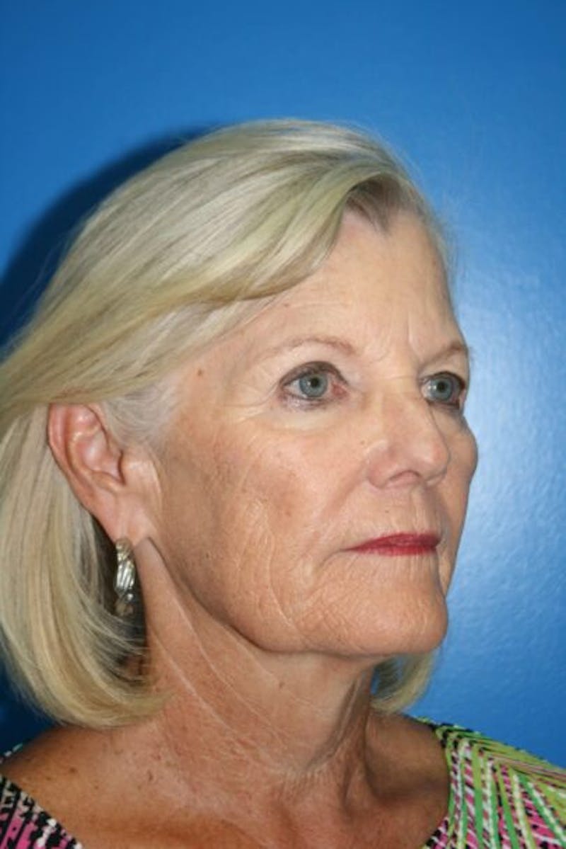 Neck Lift Before & After Gallery - Patient 920940 - Image 3