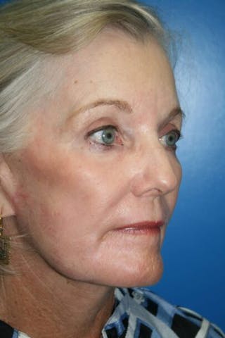 Neck Lift Before & After Gallery - Patient 920940 - Image 4