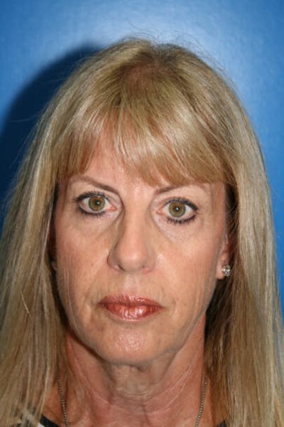 Deep Plane Facelift Before & After Gallery - Patient 147461 - Image 1