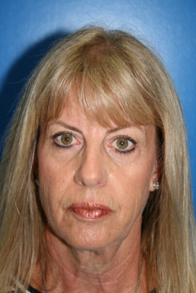 Neck Lift Before & After Gallery - Patient 300261 - Image 1