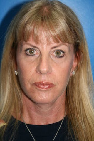 Neck Lift Before & After Gallery - Patient 300261 - Image 2