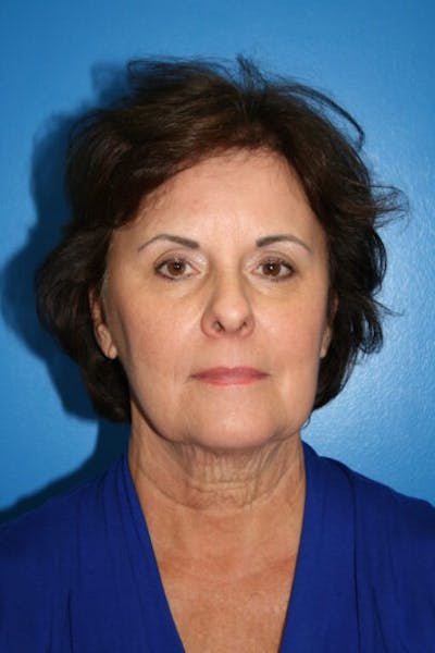 Deep Plane Facelift Before & After Gallery - Patient 116818 - Image 1