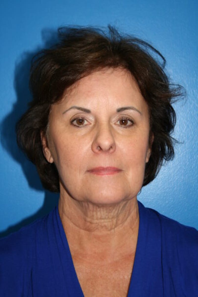 Neck Lift Before & After Gallery - Patient 370248 - Image 1