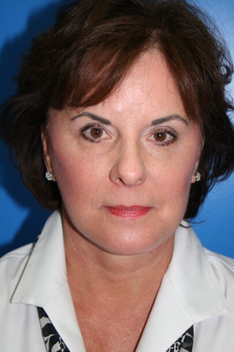 Neck Lift Before & After Gallery - Patient 370248 - Image 2