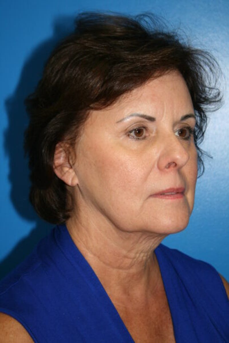 Neck Lift Before & After Gallery - Patient 370248 - Image 3