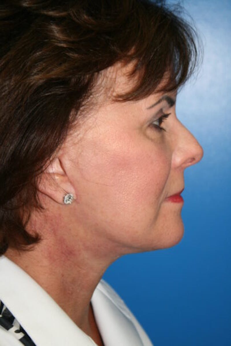 Neck Lift Before & After Gallery - Patient 370248 - Image 6