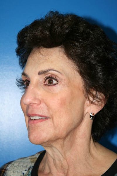 Deep Plane Facelift Before & After Gallery - Patient 235295 - Image 1