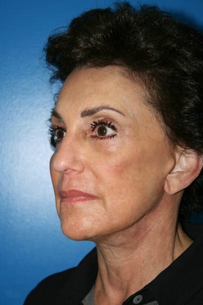 Deep Plane Facelift Before & After Gallery - Patient 235295 - Image 2