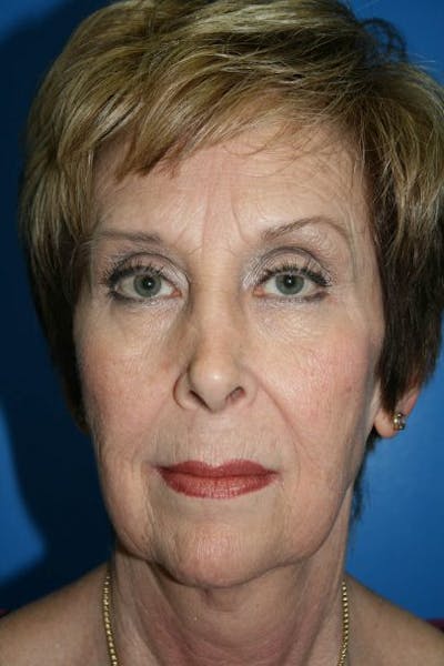 Deep Plane Facelift Before & After Gallery - Patient 350407 - Image 1