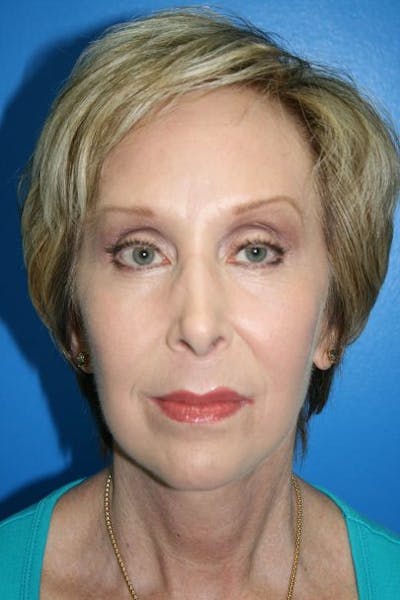Deep Plane Facelift Before & After Gallery - Patient 350407 - Image 2