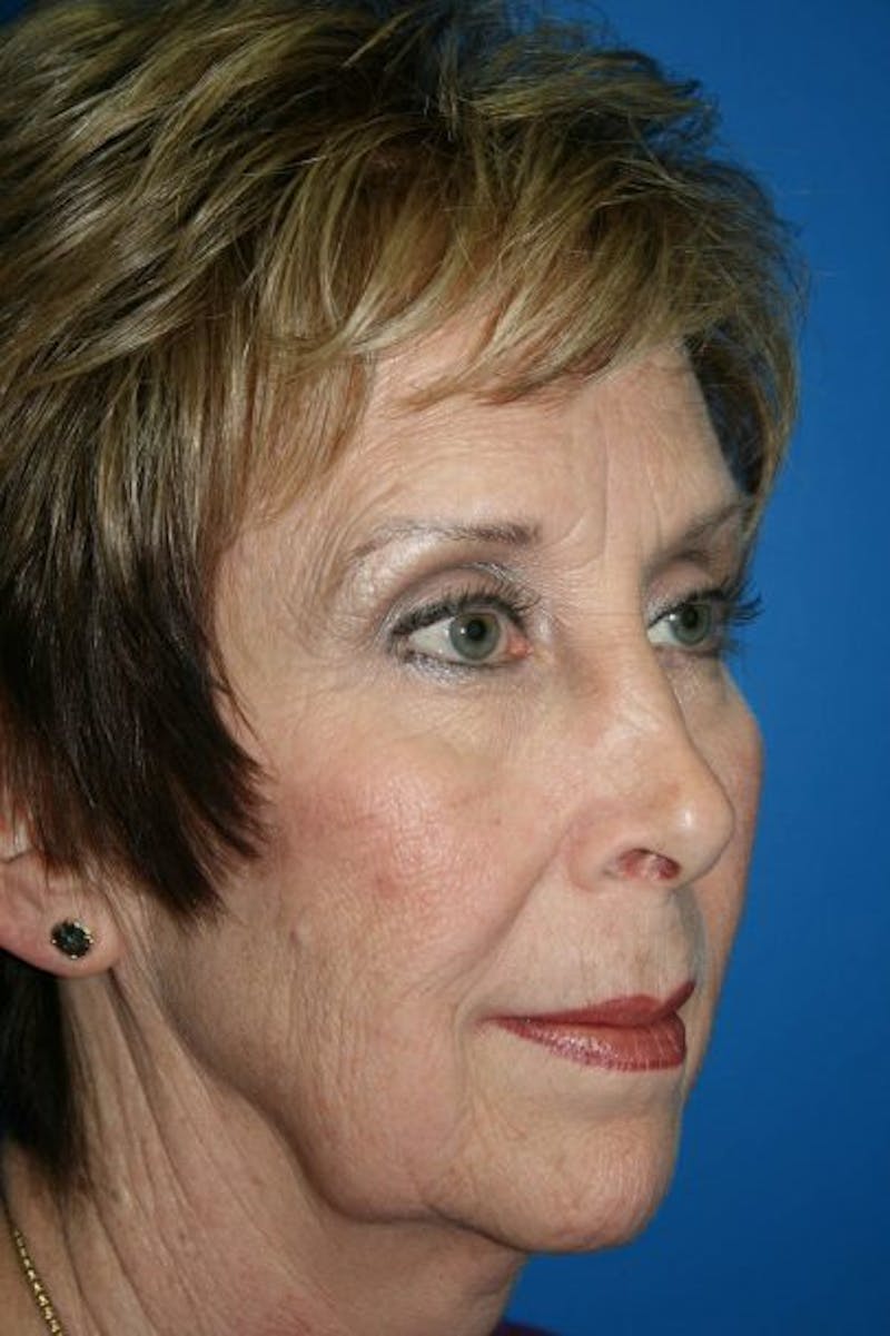 Neck Lift Before & After Gallery - Patient 220984 - Image 3