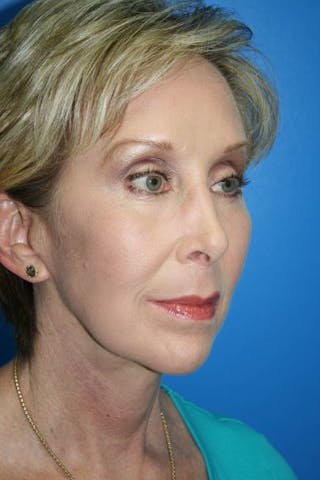 Neck Lift Before & After Gallery - Patient 220984 - Image 4