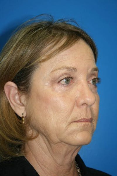Deep Plane Facelift Before & After Gallery - Patient 167823 - Image 1