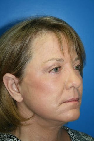 Deep Plane Facelift Before & After Gallery - Patient 167823 - Image 2
