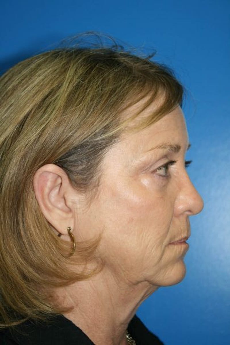 Neck Lift Before & After Gallery - Patient 275140 - Image 3