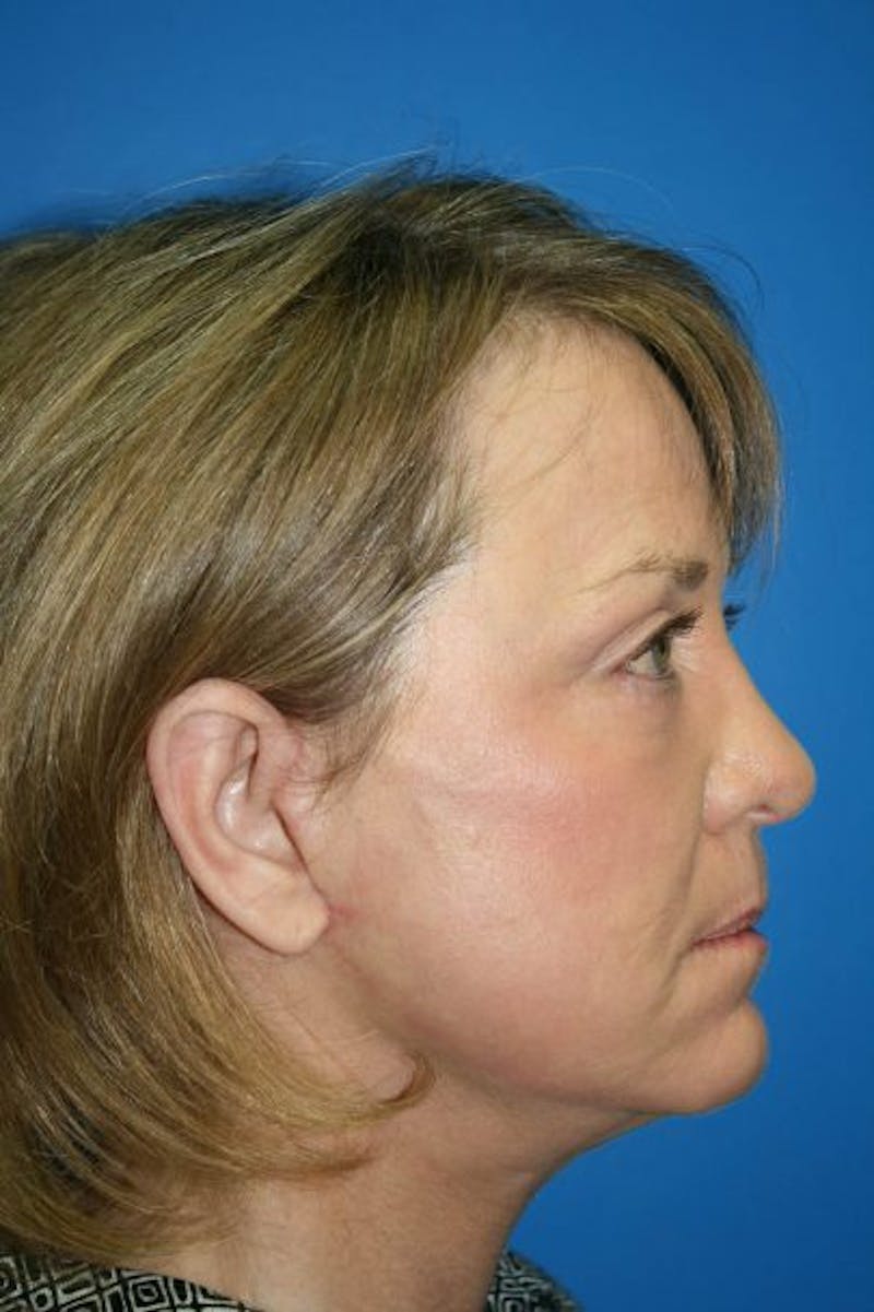 Neck Lift Before & After Gallery - Patient 275140 - Image 4