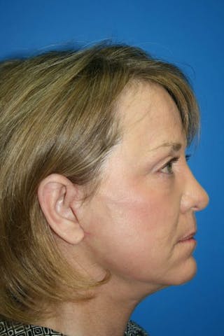 Deep Plane Facelift Before & After Gallery - Patient 167823 - Image 4