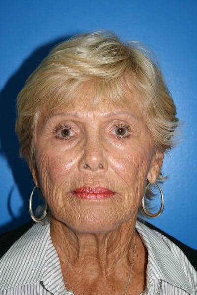 Deep Plane Facelift Before & After Gallery - Patient 542337 - Image 1