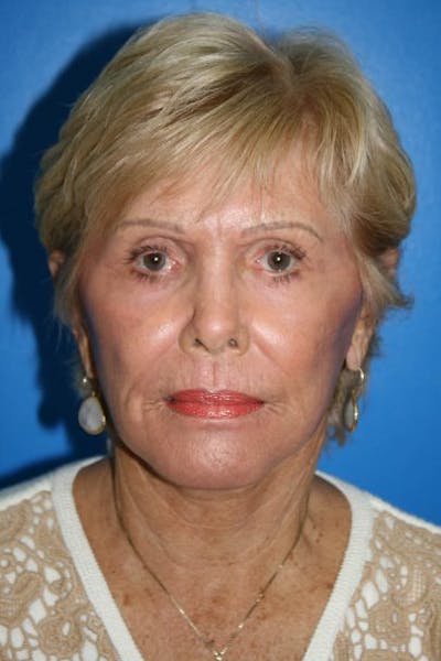 Deep Plane Facelift Before & After Gallery - Patient 542337 - Image 2