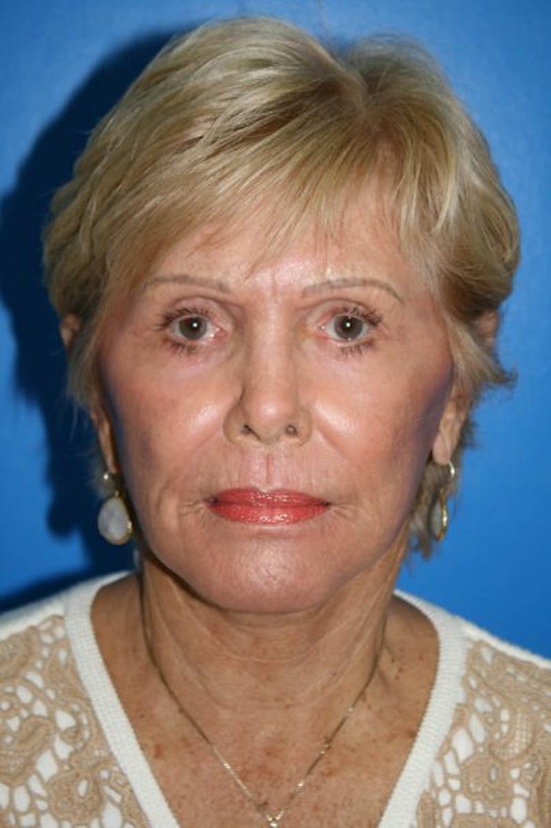 Neck Lift Before & After Gallery - Patient 404307 - Image 2
