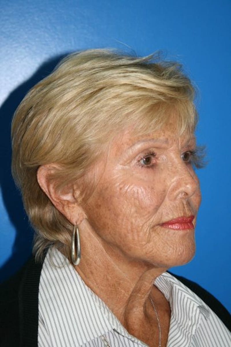 Neck Lift Before & After Gallery - Patient 404307 - Image 3