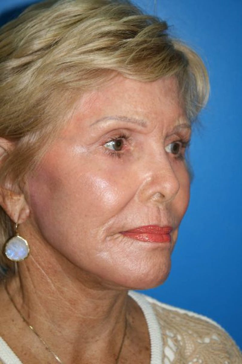 Neck Lift Before & After Gallery - Patient 404307 - Image 4