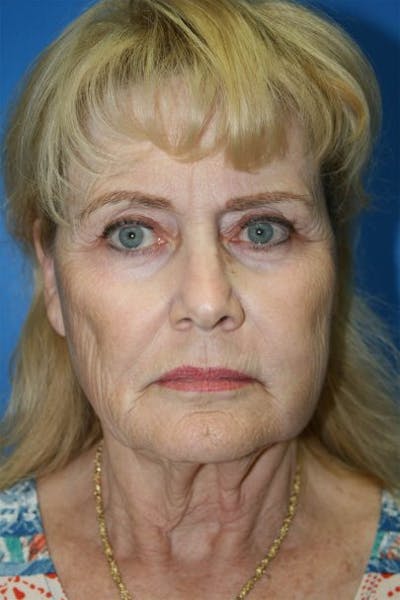Deep Plane Facelift Before & After Gallery - Patient 266509 - Image 1