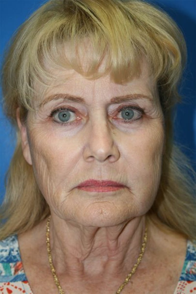 Neck Lift Before & After Gallery - Patient 241446 - Image 1