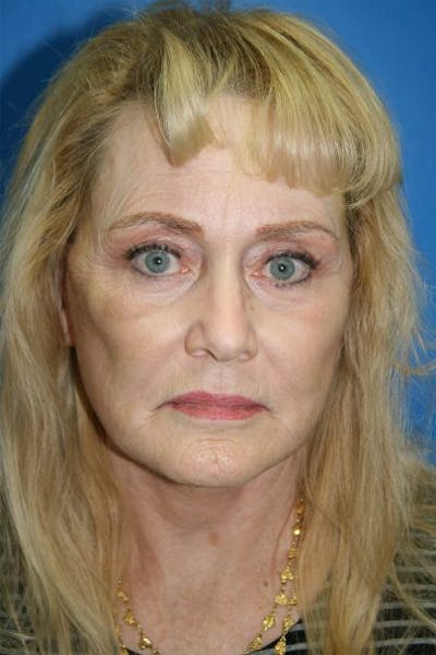 Deep Plane Facelift Before & After Gallery - Patient 266509 - Image 2