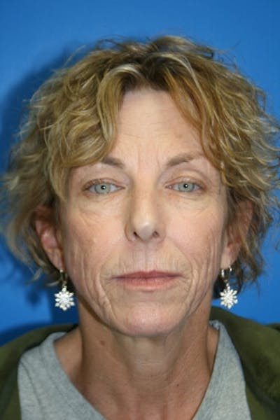 Deep Plane Facelift Before & After Gallery - Patient 363456 - Image 1