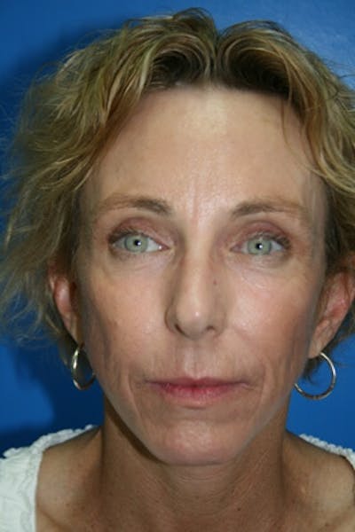Deep Plane Facelift Before & After Gallery - Patient 363456 - Image 2