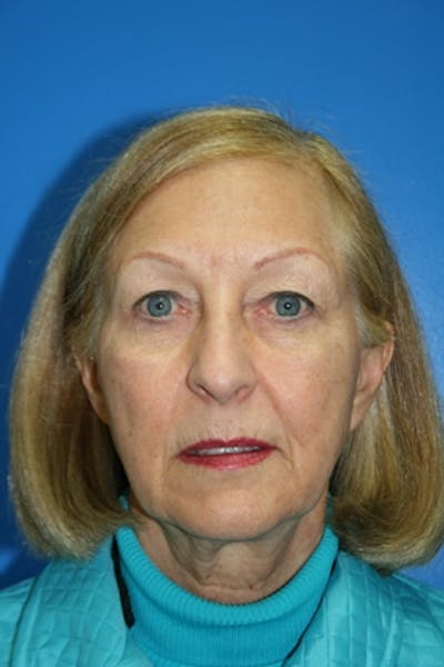 Deep Plane Facelift Before & After Gallery - Patient 990635 - Image 1