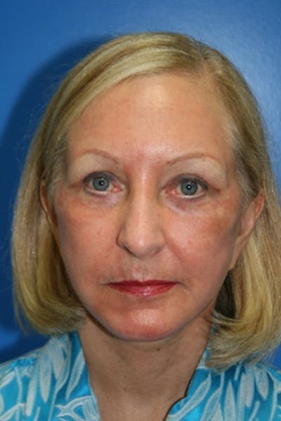 Deep Plane Facelift Before & After Gallery - Patient 990635 - Image 2