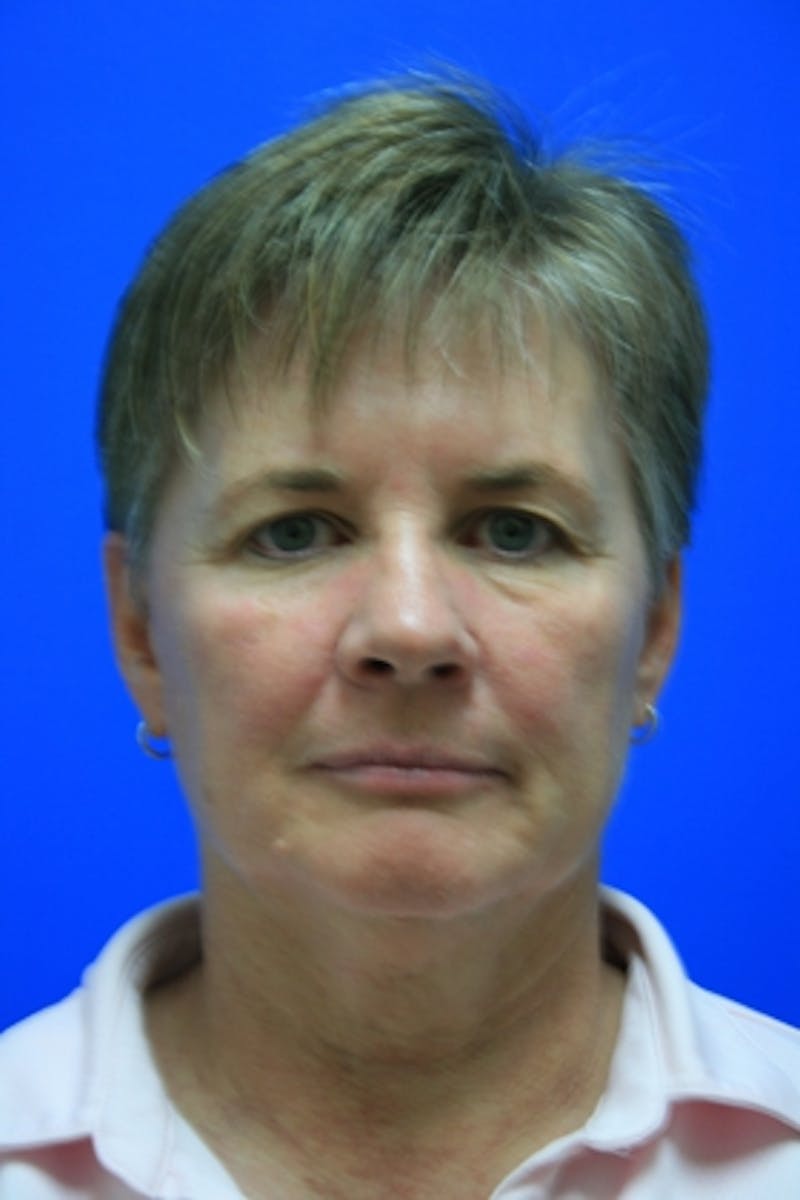 Deep Plane Facelift Before & After Gallery - Patient 485573 - Image 1
