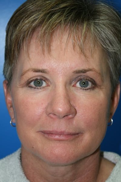 Deep Plane Facelift Before & After Gallery - Patient 485573 - Image 2
