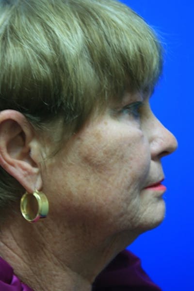 Deep Plane Facelift Before & After Gallery - Patient 233014 - Image 1