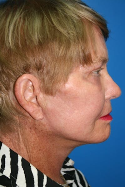 Deep Plane Facelift Before & After Gallery - Patient 233014 - Image 2