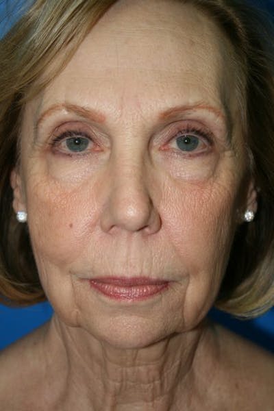 Neck Lift Before & After Gallery - Patient 740207 - Image 1