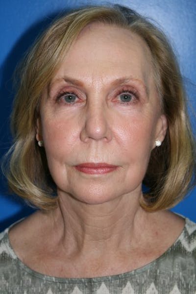 Neck Lift Before & After Gallery - Patient 740207 - Image 2