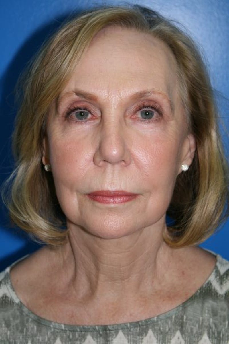 Deep Plane Facelift Before & After Gallery - Patient 294121 - Image 2