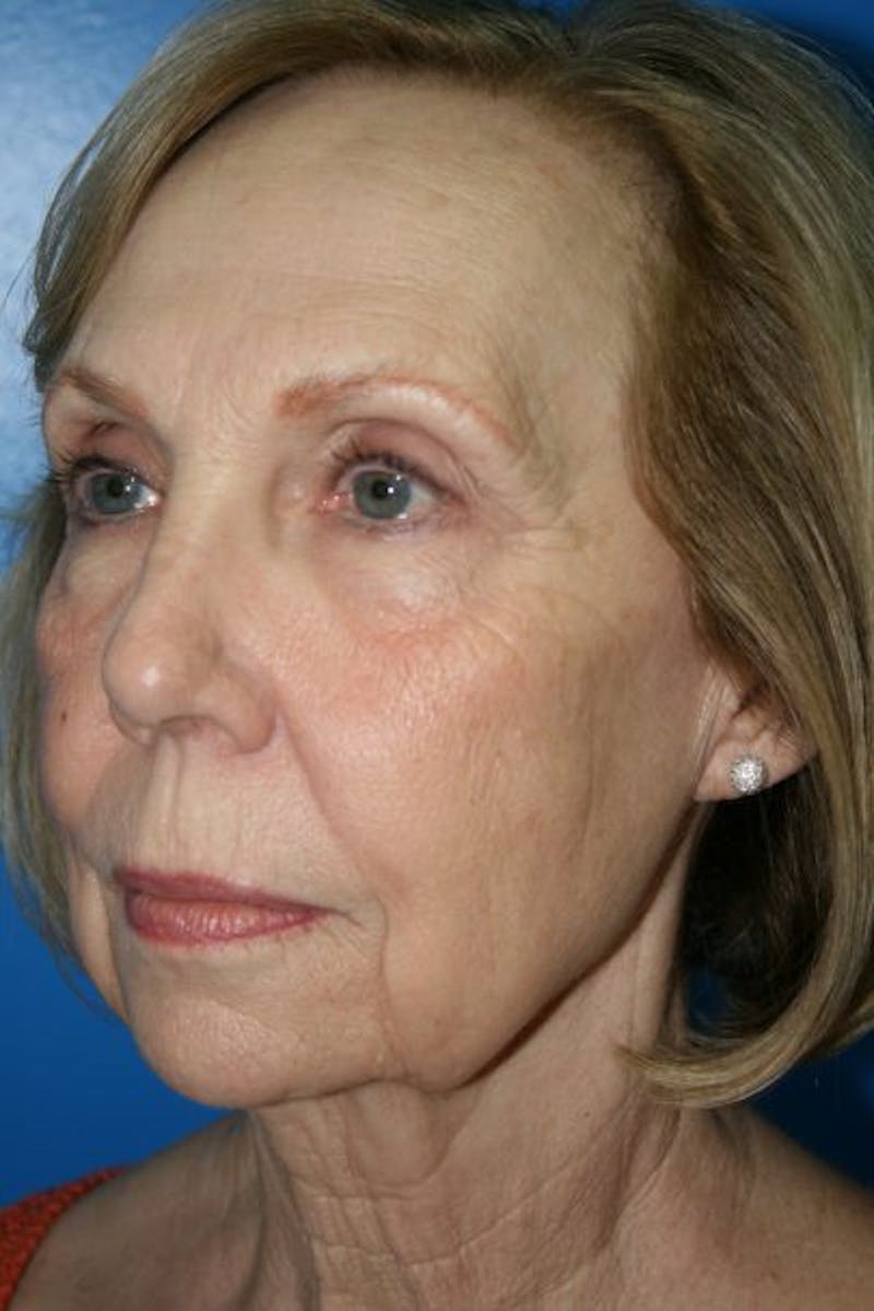Deep Plane Facelift Before & After Gallery - Patient 294121 - Image 3