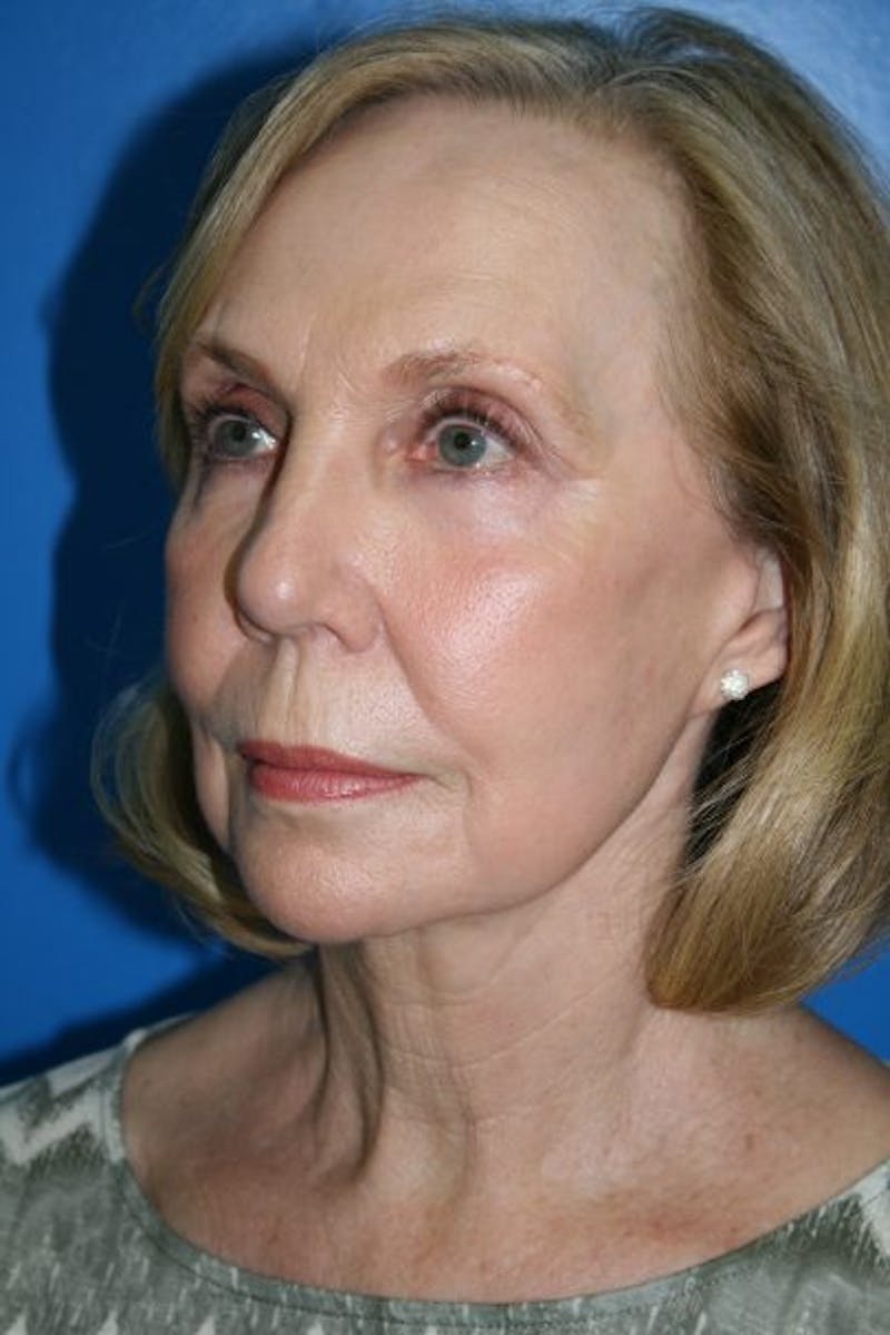 Deep Plane Facelift Before & After Gallery - Patient 294121 - Image 4