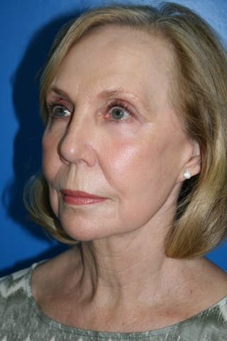 Deep Plane Facelift Before & After Gallery - Patient 294121 - Image 4